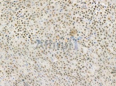 Ku70 Antibody - AF0300 at 1/100 staining human non-Hodgkin lymphoma by IHC-P.