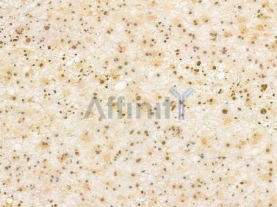 Ku70 Antibody - AF0300 at 1/100 staining human astrocytoma by IHC-P.