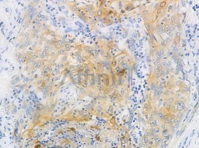 EGFR Antibody - AF0436 at 1/100 staining human esophageal carcinoma by IHC-P.