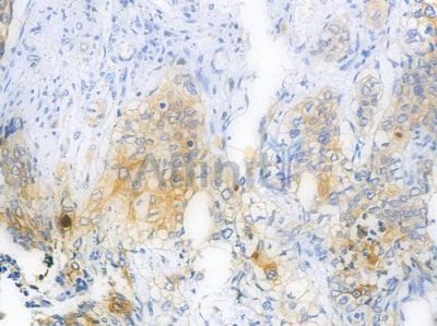 EGFR Antibody - AF0436 at 1/100 staining human lung squamous cell carcinoma by IHC-P.