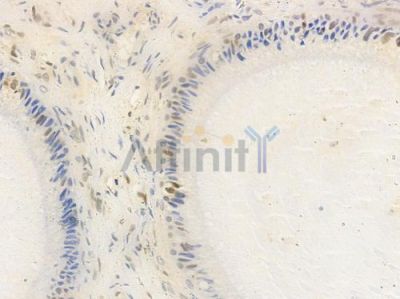 eIF4G1 Antibody - AF2641 at 1/100 staining human testicular cancer by IHC-P.