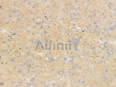 TCTP Antibody - AF2723 at 1/100 staining human glioblastoma by IHC-P.