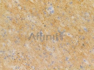 Phospho-SIK2 (Thr484) Antibody - AF3541 at 1/100 staining human glioblastoma by IHC-P.