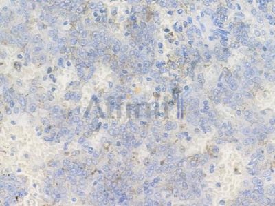 Phospho-TrkC (Tyr516) Antibody - AF3582 at 1/100 staining human melanoma by IHC-P.