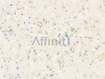 Phospho-PDHK1 (Tyr243) Antibody - AF3586 at 1/100 staining human astrocytoma by IHC-P.
