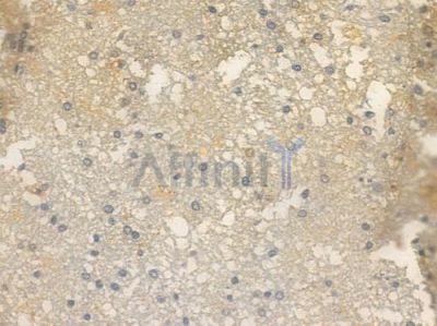 Phospho-mGluR5 (Ser870) Antibody - AF3669 at 1/100 staining human glioblastoma by IHC-P.