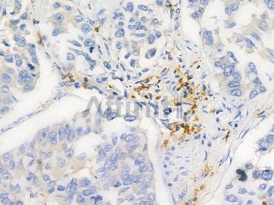 Phospho-RSK1 p90 (Thr359/Ser363) Antibody - AF3809 at 1/100 staining human lung squamous cell carcinoma by IHC-P.