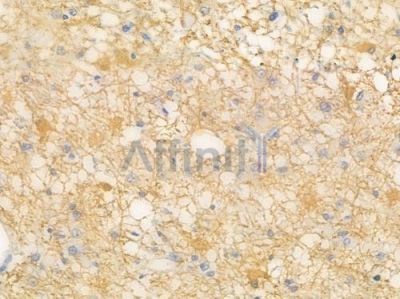 PKM2 Antibody - AF4048 at 1/100 staining human astrocytoma by IHC-P.