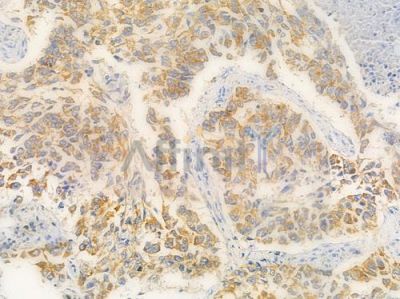 ERAB Antibody - AF4051 at 1/100 staining human lung squamous cell carcinoma by IHC-P.
