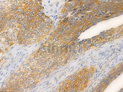 ERAB Antibody - AF4051 at 1/100 staining human cervical carcinoma by IHC-P.