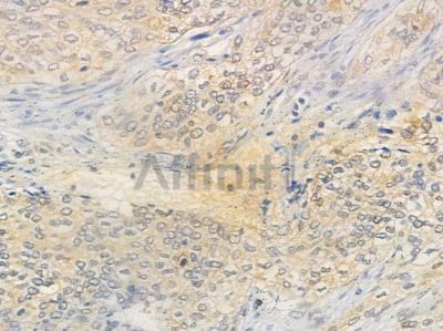 SRC3 Antibody - AF4055 at 1/100 staining human cervical carcinoma by IHC-P.
