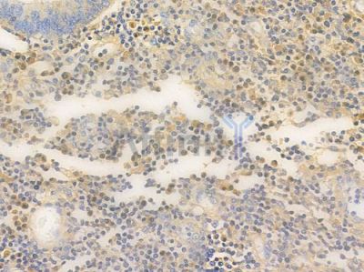 TAZ Antibody - AF4615 at 1/100 staining human colon carcinoma by IHC-P.