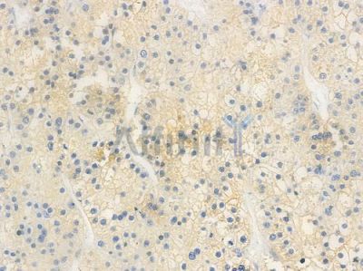 NEDD4 Antibody - AF4636 at 1/100 staining human hepatocellular carcinoma by IHC-P.