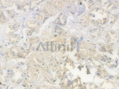 EPHA4 Antibody - AF4674 at 1/100 staining human renal cell carcinoma by IHC-P.