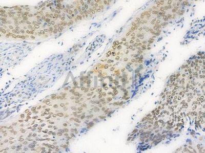 SRF Antibody - AF4703 at 1/100 staining human cervical carcinoma by IHC-P.