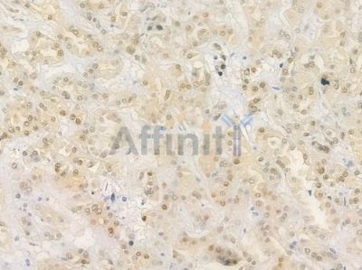 SRF Antibody - AF4703 at 1/100 staining human renal cell carcinoma by IHC-P.
