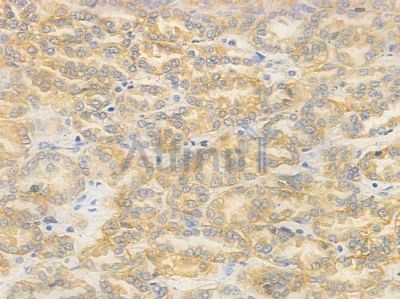 Caveolin 2 Antibody - AF5409 at 1/100 staining human renal cell carcinoma by IHC-P.