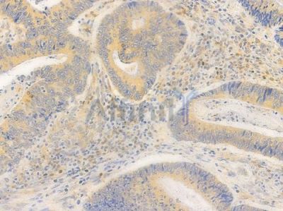AR Antibody - AF6137 at 1/100 staining human colon carcinoma by IHC-P.