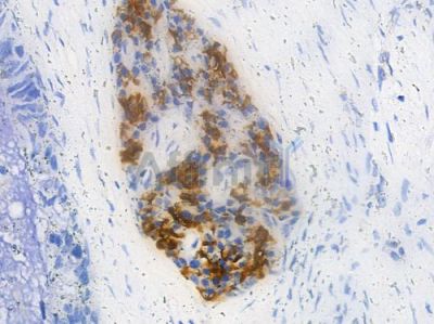 Rel Antibody - AF6395 at 1/100 staining human pancreatic carcinoma by IHC-P.