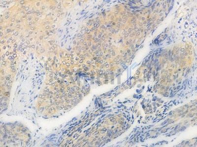 FOXO1A Antibody - AF6416 at 1/100 staining human cervical carcinoma by IHC-P.