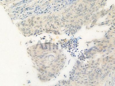 AMPK alpha 1 Antibody - AF6422 at 1/100 staining human cervical carcinoma by IHC-P.