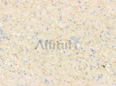 GAB1 Antibody - AF6429 at 1/100 staining human astrocytoma by IHC-P.