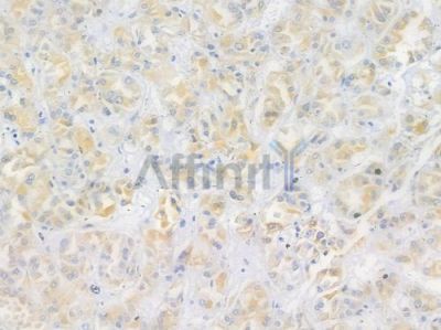 Cortactin Antibody - AF6436 at 1/100 staining human renal cell carcinoma by IHC-P.