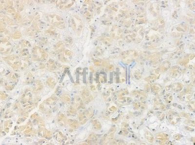 p38 MAPK Antibody - AF6455 at 1/100 staining human renal cell carcinoma by IHC-P.