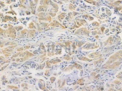CDC37 Antibody - AF6458 at 1/100 staining human lung adenocarcinoma by IHC-P.