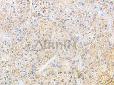 WNK1 Antibody - AF6483 at 1/100 staining human hepatocellular carcinoma by IHC-P.