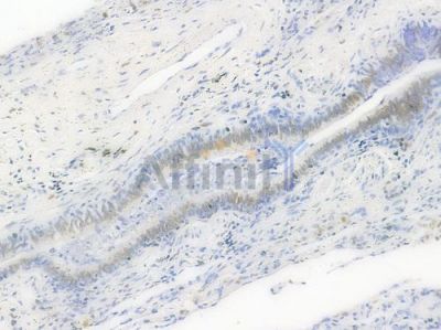 SAMHD1 Antibody - AF6508 at 1/100 staining human lung squamous cell carcinoma by IHC-P.