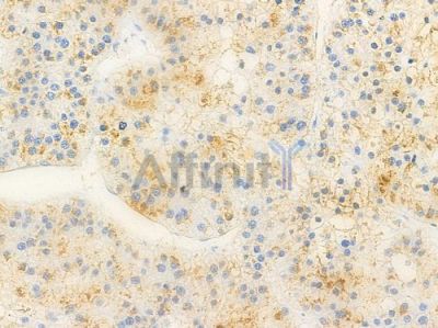 SIK2 Antibody - AF6541 at 1/100 staining human hepatocellular carcinoma by IHC-P.