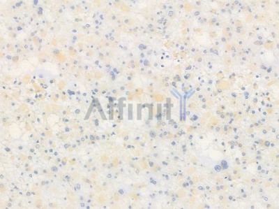 Optineurin Antibody - AF6560 at 1/100 staining human astrocytoma by IHC-P.