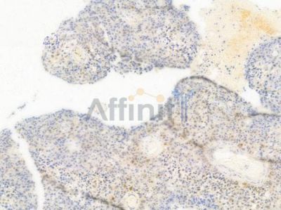 PPP1CA Antibody - AF6638 at 1/100 staining human glioblastoma by IHC-P.