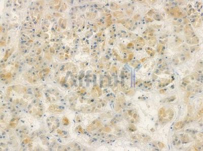 ABCA1 Antibody - AF6758 at 1/100 staining human renal cell carcinoma by IHC-P.
