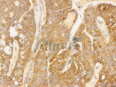 Mitofusin 2 Antibody - AF6760 at 1/100 staining human ovarian carcinoma by IHC-P.