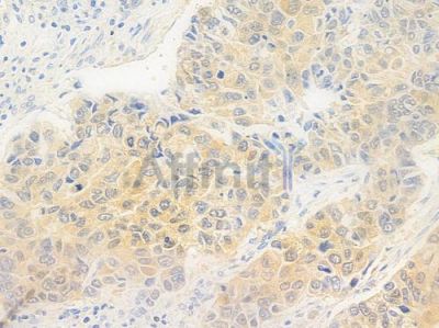 p23 Antibody - AF6794 at 1/100 staining human lung squamous cell carcinoma by IHC-P.