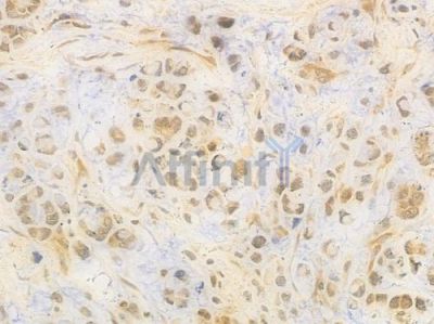 NF-kB p65 Antibody - AF6795 at 1/100 staining human gastric carcinoma by IHC-P.