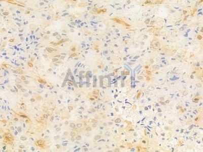 ARRB1 Antibody - AF6806 at 1/100 staining human prostate carcinoma by IHC-P.