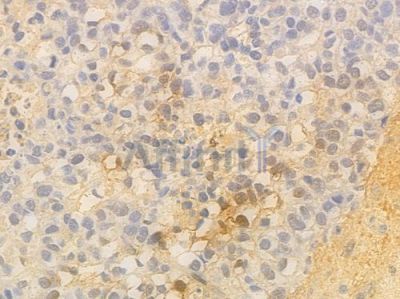 NFAT1 Antibody - AF6882 at 1/100 staining human glioblastoma by IHC-P.