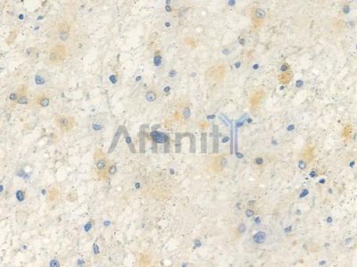 PSD95 Antibody - AF6884 at 1/100 staining human astrocytoma by IHC-P.
