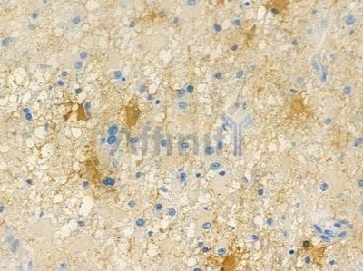 Claudin 6 Antibody - AF6972 at 1/100 staining human astrocytoma by IHC-P.