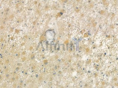 TUBB3 Antibody - AF7000 at 1/100 staining human astrocytoma by IHC-P.