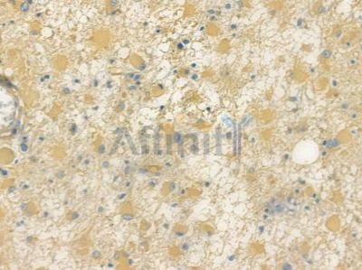 KCNH2 Antibody - AF7540 at 1/100 staining human astrocytoma by IHC-P.