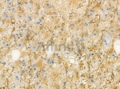 PLD2 Antibody - AF7603 at 1/100 staining human astrocytoma by IHC-P.