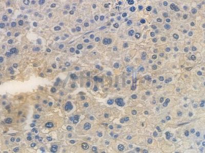 TAK1 Antibody - AF7617 at 1/100 staining human hepatocellular carcinoma by IHC-P.