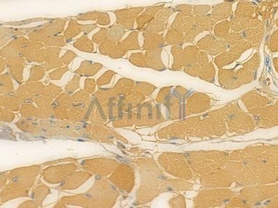 FOXO3A Antibody - AF7624 at 1/100 staining human tongue carcinoma by IHC-P.