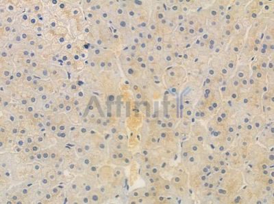 ULK1 Antibody - AF7647 at 1/100 staining human hepatocellular carcinoma by IHC-P.