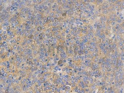 STAM2 Antibody - AF7658 at 1/100 staining human prostate carcinoma by IHC-P.