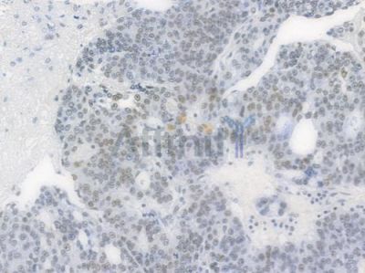 Nucleophosmin Antibody - AF7703 at 1/100 staining human ovarian carcinoma by IHC-P.